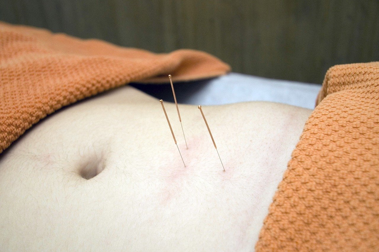 Acupuncteurs en France